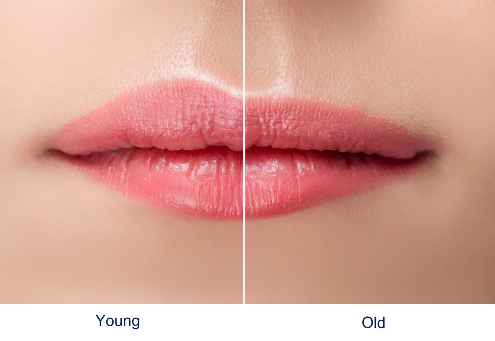 Lip-Fillers-for-Aging-or-Thin-Lips